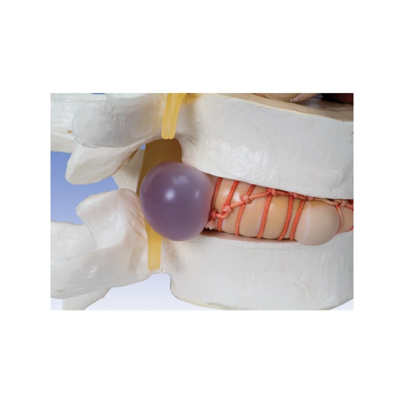 Simulateur d'Hernie Discale - Ostéologie - sisselpro.fr