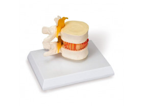 Simulateur d'Hernie Discale - Matériel ostéologie - sisselpro.fr