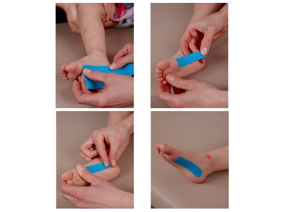 Application de K-Taping® sous la voute plantaire d'un enfant Application de K-Taping® sous la voute plantaire d'un enfant